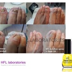 Schimmelnagelbehandeling