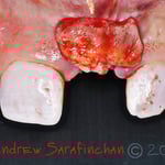 Формування м'яких тканин довкола імплантанта в естетичній ділянці