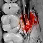 Забір сполучно тканинного трансплантату із піднебіння