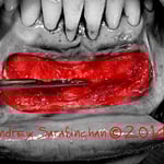 Поглиблення присінку рота на нижній щелепі