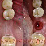 Створення благоприємних умов для функціонування коронки на імплантаті