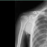 鎖骨骨折　整復　保存療法　国分寺　こみね鍼灸整骨院