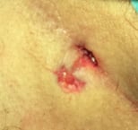 Wunde nach Pit Picking bei Steissbeinfistel