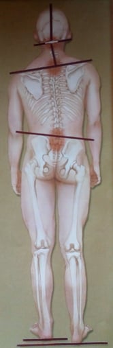 Beckenschiefstand Beinlängendifferenz