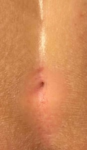 Ein Pit bei einer Steißbeinfistel - Proktologie Berlin