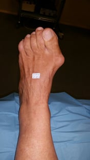 Juanete, antes de ser sometido a tratamiento quirúgico