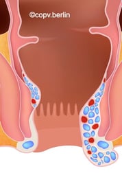 Hämorrhoiden Grad 4 - Proktologie Berlin