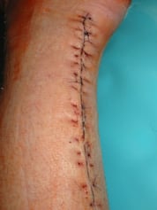 Montag 06.06.2005 jeder 2te Faden wurde gezogen, zwickt etwas, aber ansonsten nicht schlimm