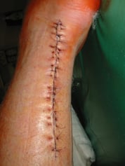 Mittwoch 01.06.2005 erste Nahtkontrolle beim Unfallarzt Dr. Grobe