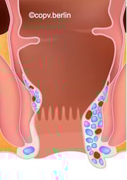 Hämorrhoiden Grad 3 - Proktologie Berlin