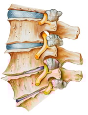腰の不安定化はぎっくり腰や急性腰痛の原因となることがあります