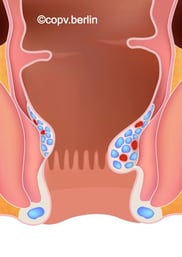 Hämorrhoiden Grad 1 - Proktologie Berlin