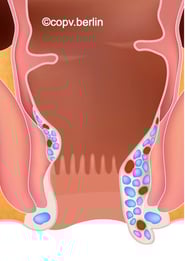 Hämorrhoiden Grad 3 - Proktologie Berlin COPV