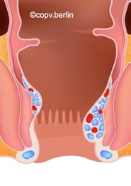 Hämorrhoiden Grad 2 - Proktologie Berlin COPV