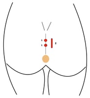 Pit picking in pilonidal cyst
