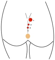 Lasertherapie bei Steissbeinfistel (Sinus pilonidalis)