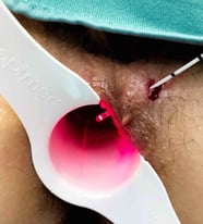 Analfistel mit Fistelverschluß mittels Laser FiLac - Proktologie Berlin