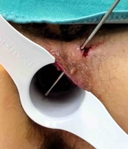 Analfistel Darstellung mit Sonde - Proktologie Berlin