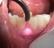 ポケットレーザー照射