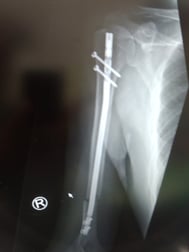 上腕骨骨折　外科手術　手術後のリハビリが全くされていないので浮腫、出血により関節拘縮　循環障害　国分寺こみね鍼灸整骨院