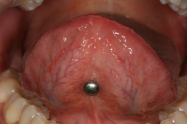 Piercing lingual en rapport avec la récession gingivale ci-contre © ParoSphère