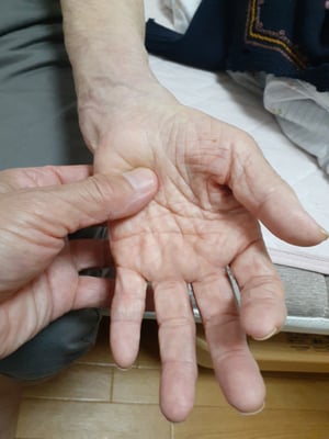 指の拘縮もなく経過良好　保存療法　国分寺こみね鍼灸整骨院