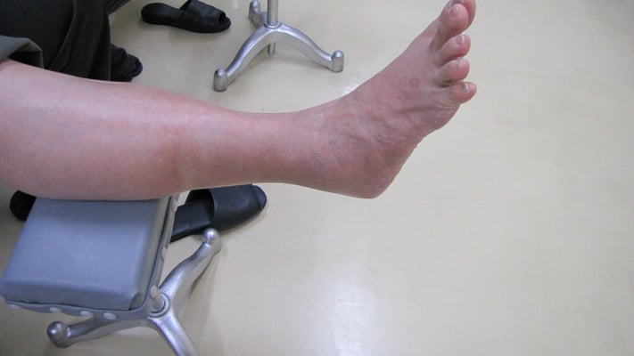 右腓骨骨折　浮腫み　関節拘縮なし　保存療法　国分寺　こみね鍼灸整骨院