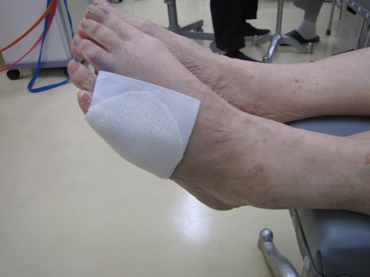 左第五中足骨骨折　簡易固定　保存療法　国分寺こみね鍼灸整骨院