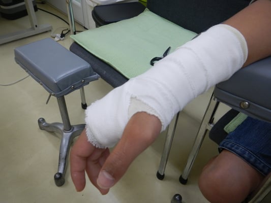 圧迫を軽減するための窓あきギプス　保存療法　国分寺こみね鍼灸整骨院