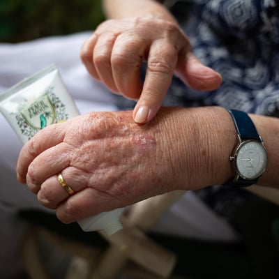 Handtherapie bei Arthrose, Gicht, Artritis, Gelenkschmerzen, Ergotherapie Praxis  Stein am Rhein und Ergotherapie Praxis Berlingen, Untersee u. Rhein