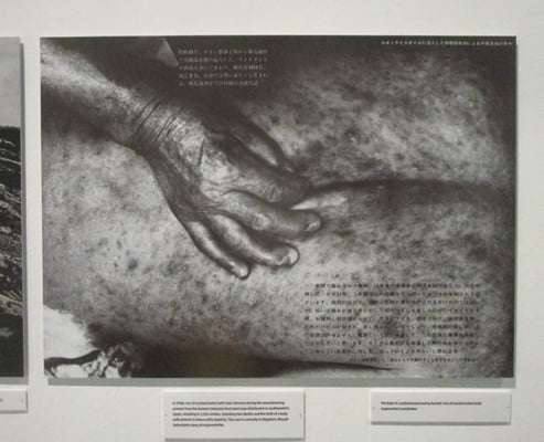 カネミ・ライスオイルに混入した有機塩素剤中毒患者の背中。 「私たちのエコロジー展」森美術館展示より。 全日本学生写真連盟公害キャンペーン実行委員会 『この地上に われわれの国はない：公害キャンペーン写真集』 1970　東京都写真美術館蔵