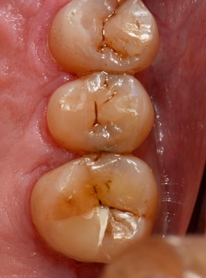 症例２と同じ患者さんの第二小臼歯遠心面