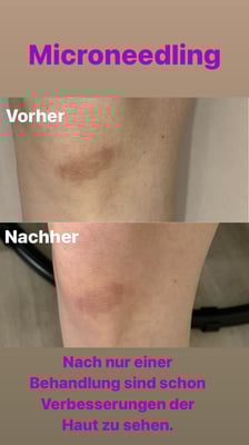 Microneedling, Hautnarbe an Knie, Vergleich "vorher - nachher"