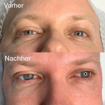 Microneedling, Augenpartie, Vergleich "vorher - nachher"