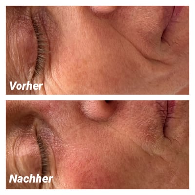 Seidenfadenlifting, Augen- & Wangenfalten, Vergleich "vorher - nachher"