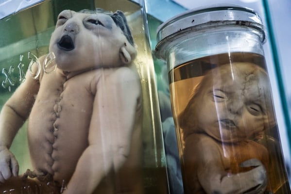 Malformed phoetus due to radiation from the Polygon. One of the consequences of contamination due to the polygon is births defects, malformations and genetic mutations.  Institute of anatomy pathology, Semey.