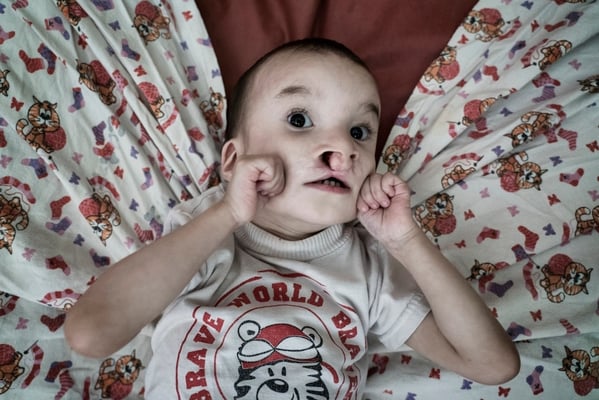 Mukasheva Mariya, 3 years old, mental retardation and cleft lip.  Mukasheva Mariya is a victim of the polygon. Her parents lived in a contaminated village close to the polygon. She was abandoned when she was born. Orphanage for handicapped children, Semey