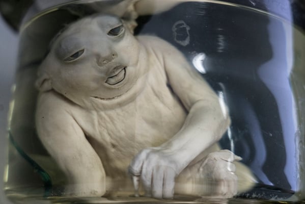 Malformed phoetus due to radiation from the Polygon. One of the consequences of contamination due to the polygon is births defects, malformations and genetic mutations.  Institute of anatomy pathology, Semey.