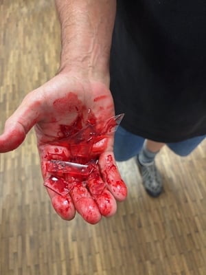 Schnittwund in Handinnenfläche