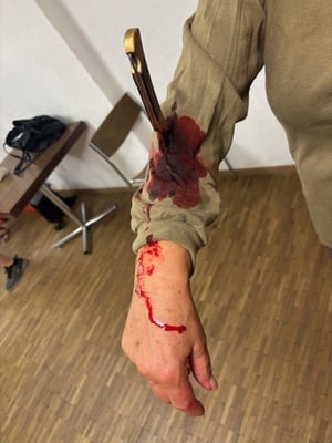 Stichverletzung am Unterarm