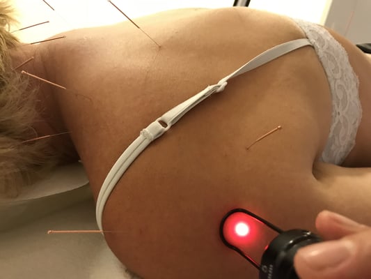 Arthrosetherapie: Akupunktur+Laser
