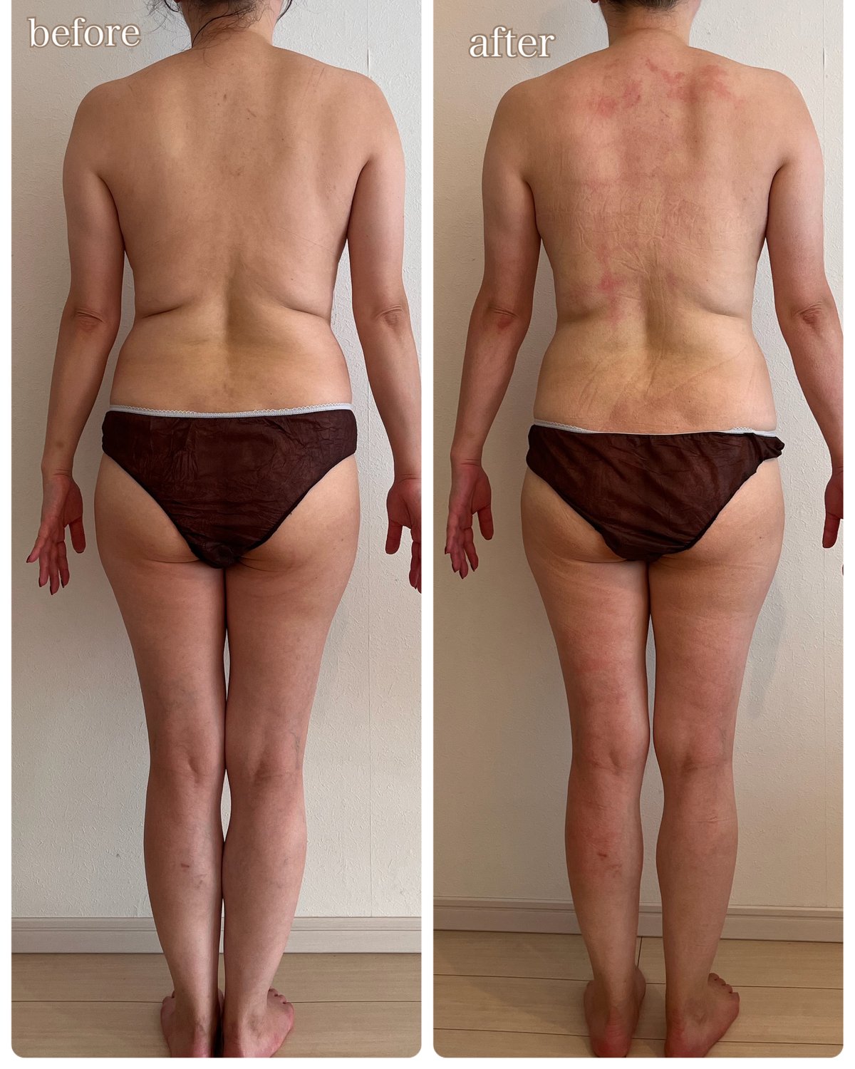 たった1回で上半身のお肉がこんなになくなって感激！