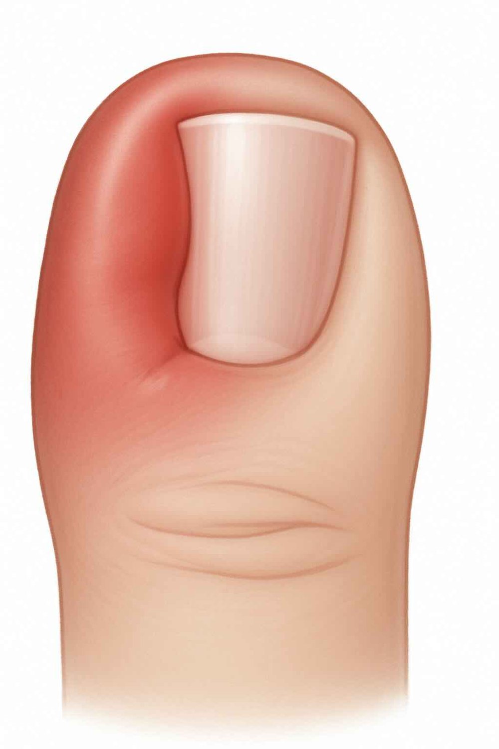 Eingewachsener Zehennagel (Unguis incarnatus): Ursachen, Behandlung & moderne Therapien