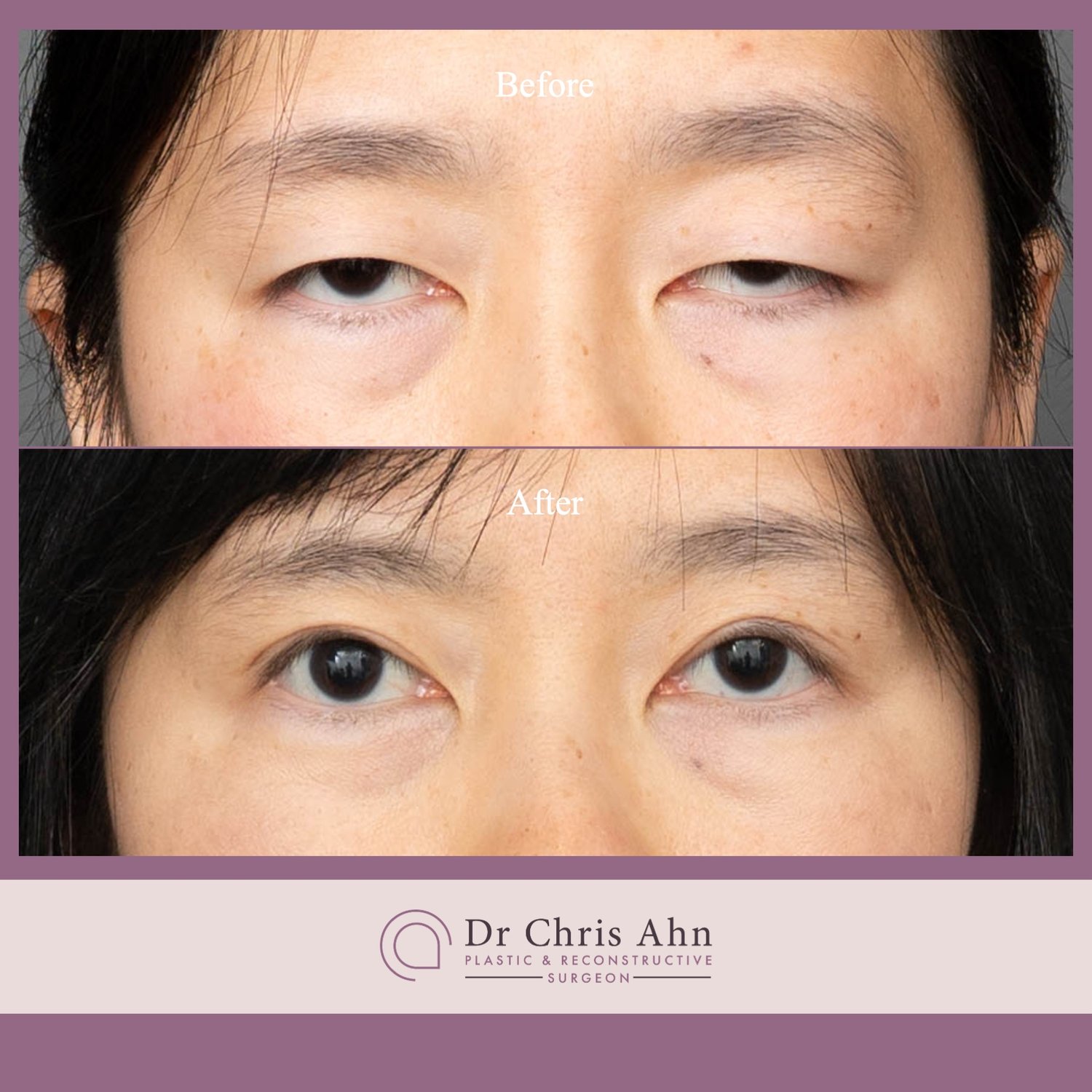 Understanding Upper Eyelid Ptosis Correction: What to Expect Before, During, and After Treatment