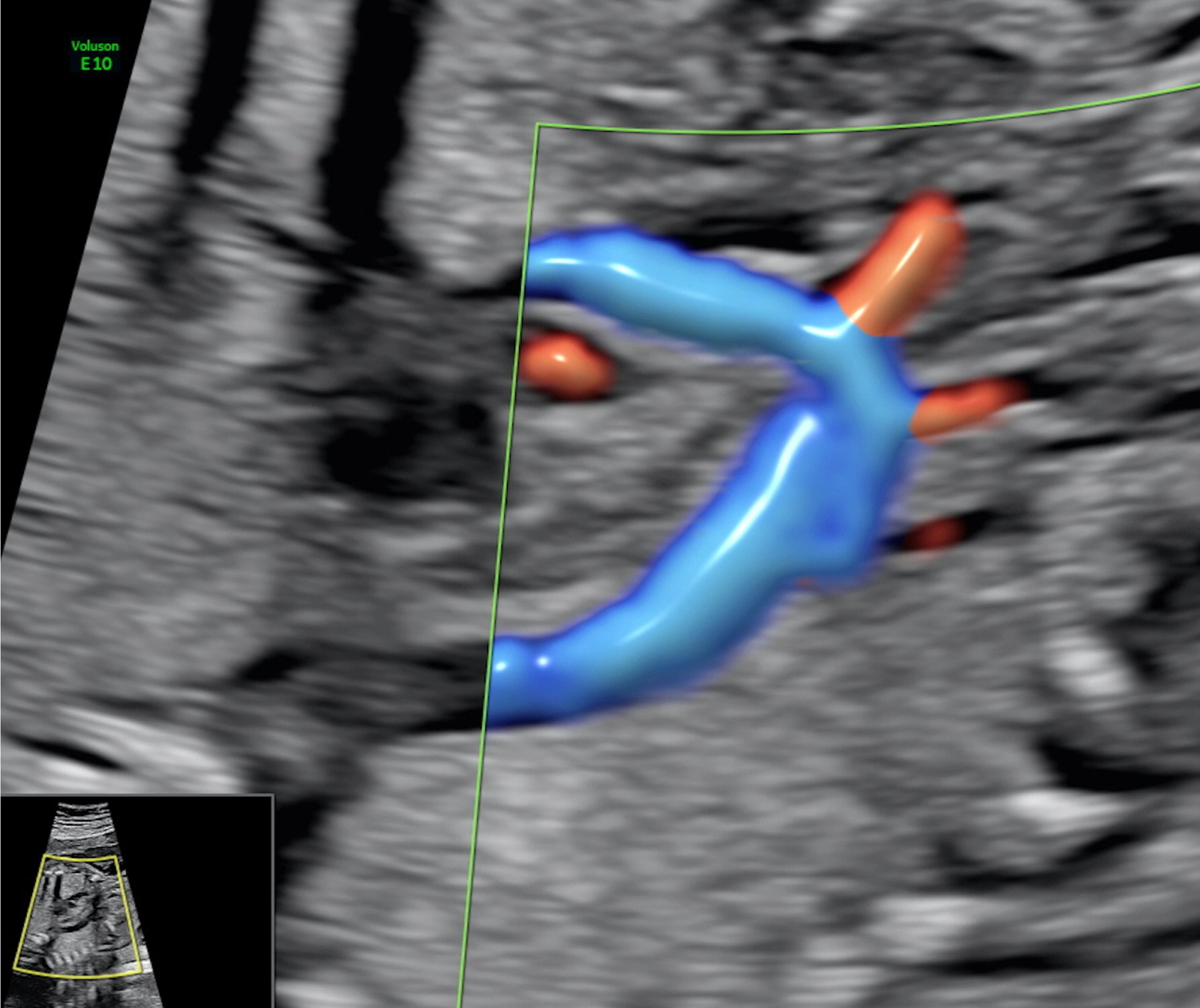 Fokustag "Fetale Echokardiographie", 29. April 2023: Restplätze noch frei!