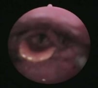 嚥下中の内視鏡像