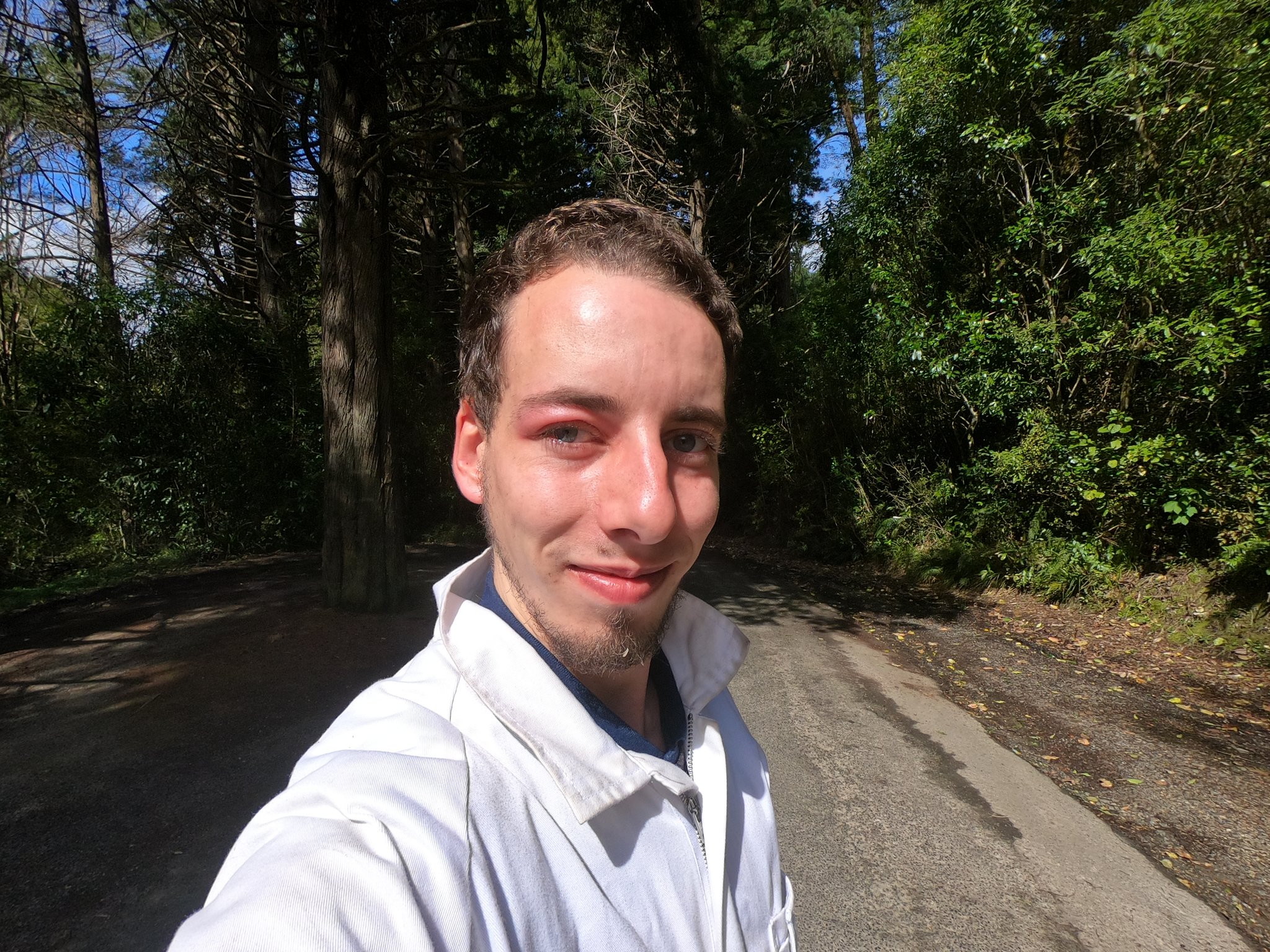 Une heure après la piqûre de la paupière droite...