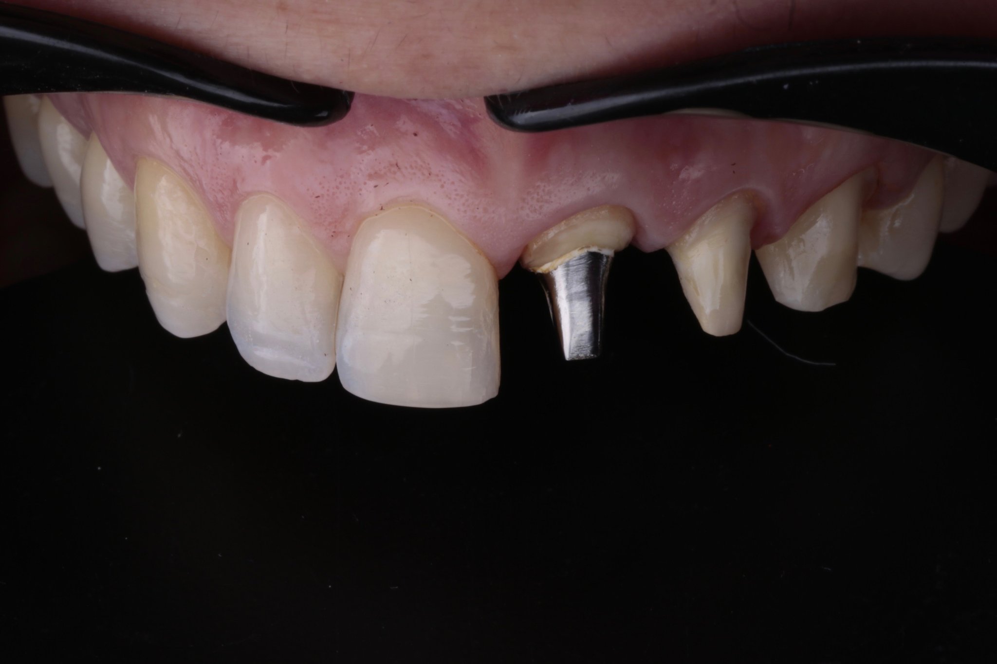 Case-1. Metal abutment pin on 1.1