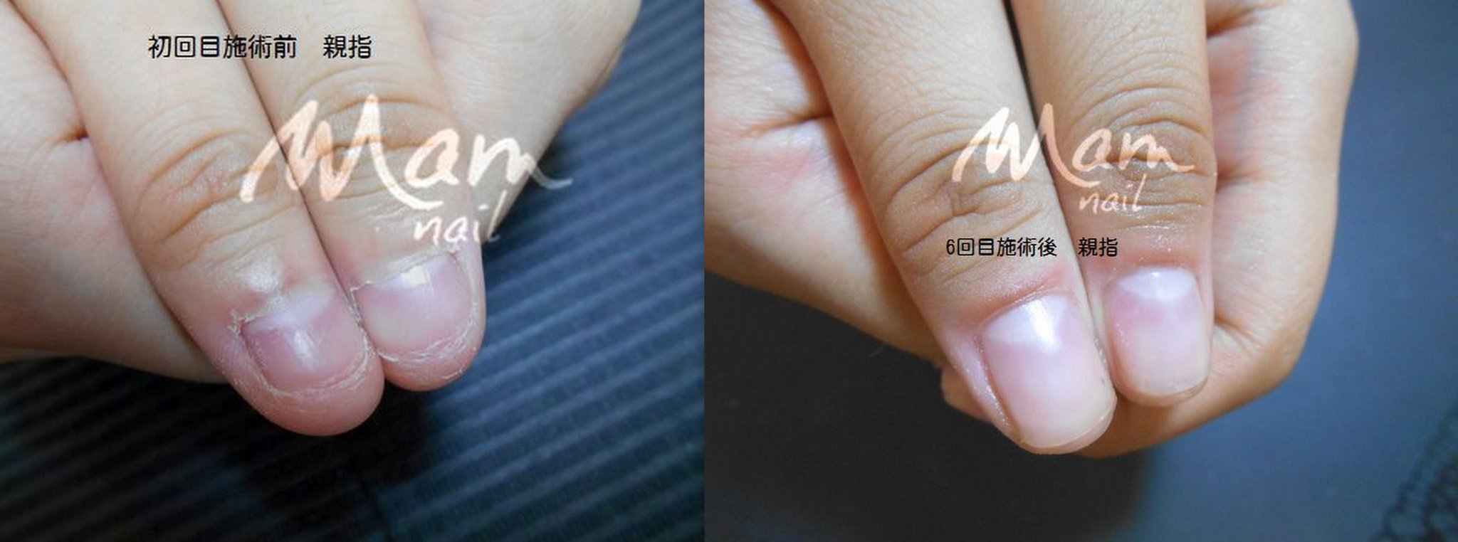 富士市深爪矯正/深爪中度