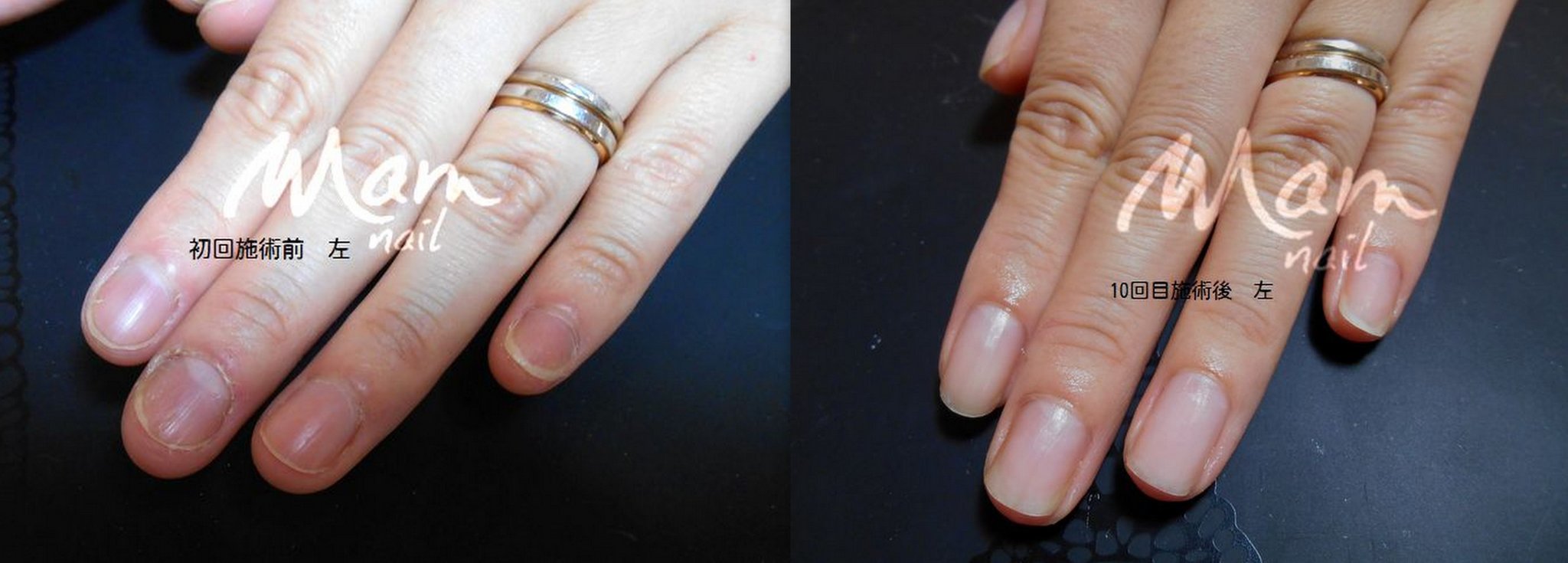 富士市深爪矯正/深爪重度